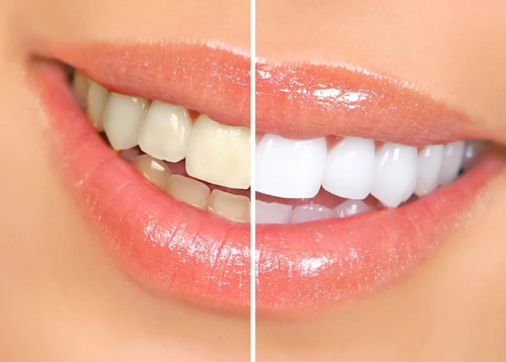 Experience the Benefits of Cosmetic Dentistry for a Beautiful and Confident Smile