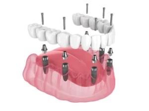 Full-arch restoration supported by six dental implants