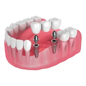 Implant-supported bridge replacing multiple missing teeth