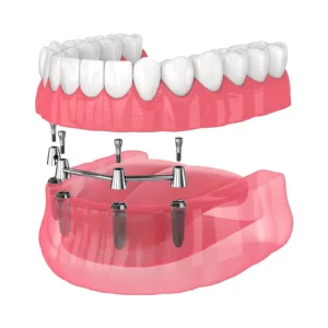 Implant-supported removable denture on a retention bar