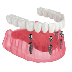 Full-arch prosthesis supported by four dental implants