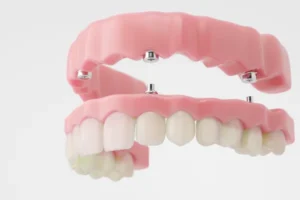 Full upper and lower dentures replacing all the teeth in both arches