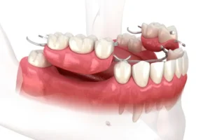Upper and lower partial dentures clasped to the remaining natural teeth