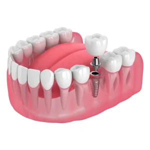 Single dental implant supporting an individual crown